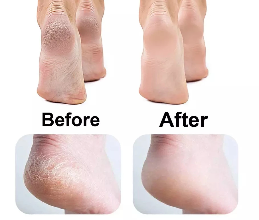 Lot de 3 Têtes de Rechange - Soins des Pieds – Image 2